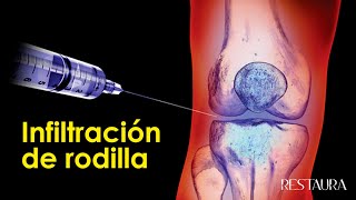 Infiltración de rodilla  Todo lo que necesitas saber [upl. by Hillel]