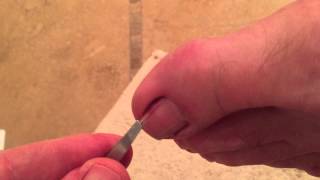 Another ingrown toenail fixed in less than 2 minutes [upl. by Watt]