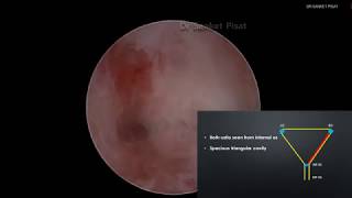 Hysteroscopic Synechiolysis Ashermans Syndrome Surgical Technique with voiceover [upl. by Condon]