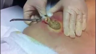 Biggest Pimple Pop Ever Seen 2016 Caught On Camera Guiness World Records Biggest Pimple Ever [upl. by Nhguaved]