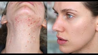 HOW I CURED MY ACNE BY DETOXING FROM TOXINS Part 4 [upl. by Orimlede]