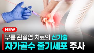 퇴행성 관절염 수술 없이 주사 치료한다 자가골수 줄기세포 치료  절차 비용 시술 후 관리 大 공개 [upl. by Twila]