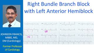 Right bundle branch block with left anterior hemiblock [upl. by Yssak280]