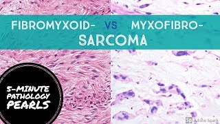 FIBROmyxo vs MYXOfibro Sarcoma Made Simple 5Minute Pathology Pearls [upl. by Ahsemed]