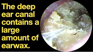 The deep ear canal contains a large amount of earwaxear wax removal  ear cleaning  ASMR [upl. by Jollenta900]