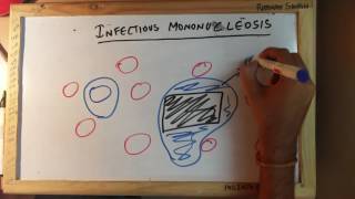 Infectious Mononucleosis [upl. by Selrac]