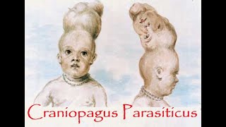 Craniopagus Parasiticus – a parasitic head protruding from temporal area of cranium [upl. by Iaverne382]