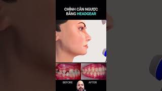 headgear orthodontics braces dentalcare satisfying [upl. by Oirretno913]