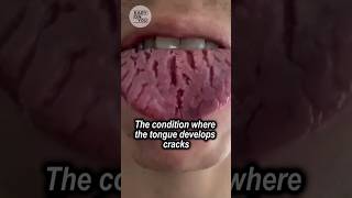 Exploring Fissured Tongue A Painful Condition with Unknown Causes [upl. by Arlie241]