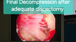 InterLaminar Endoscopic Discectomy Awake Spine Surgery Dr Rohit Thaker sciaticatreatment spine [upl. by Hickey]