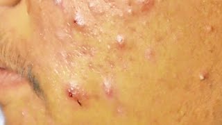 Extraction boutons et drainage le pus suintant dun acné kystique sur le visage  cystic acne [upl. by Oderfliw801]