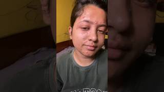 My chicken pox journey  golposongeshreya bengalivlog chickenpox pox [upl. by Bergstein]