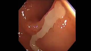 Diphyllobothrium latum on colonoscopy [upl. by Sefton]