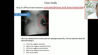 Case 41 how to differentiate between pneumothorax and pneumatocele Localized air [upl. by Novihc]