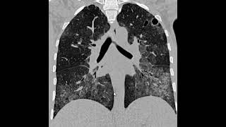 PCP Pneumonia por pneumocystis Jirovecii [upl. by Fonseca885]