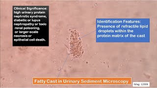 Fatty Casts in urine Microscopy [upl. by Kilian]