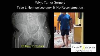 Treatment for Bone Cancer Chondrosarcoma Pelvic Tumour SurgeryHemipelvectomy Dr Srimanth B S [upl. by Leuqim363]