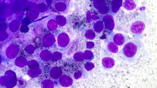 Melanoma cytological interpretation explained [upl. by Ajet]