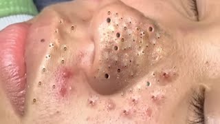 Big Cystic Acne Blackheads Extraction Blackheads amp Milia Whiteheads Removal Pimple Popping  402 [upl. by Araeic]