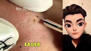 satisfying removal Blackheads satisfying blackheads [upl. by Elocal]