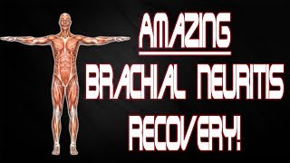 Brachial Neuritis Parsonage Turner 3 Months  Rapid Recovery [upl. by Ahsem]