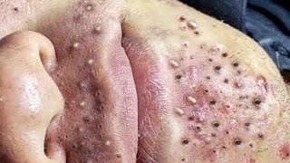 Big Cystic Acne Blackheads Extraction Blackheads amp Milia Whiteheads Removal Pimple Popping  2950 [upl. by Ynnel]