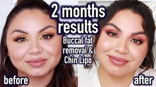 My 2 months Results  Chin Lipo and Buccal Fat Removal Surgery  Am I happy with the final result [upl. by Eustasius]