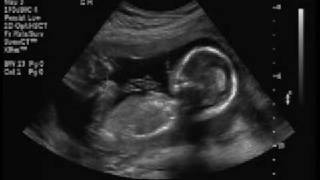 Baby Girl Ultrasound at 18 Weeks [upl. by Erna930]