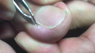 Ingrown Toenail Removal [upl. by Eiramac]