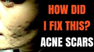 How to treat acne scars  Dermatologist explains [upl. by Etteyafal]