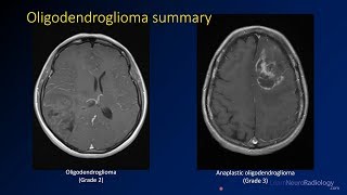 Imaging brain tumors  3  Oligodendrogliomas [upl. by Yrojram]