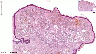 Capillary Hemangioma  Skin Histopathology [upl. by Marx]