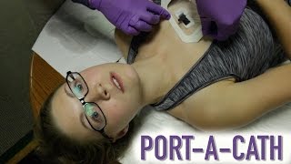 HOW TO ACCESS A PORTACATH IMPLANTED PORT [upl. by Nyrem831]