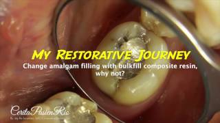 Change amalgam filling with composite resin tambalan pada gigi posterior kasus karies sekunder [upl. by Sivrat]