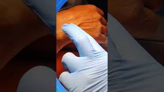 IV line insertion tips [upl. by Arikaahs]