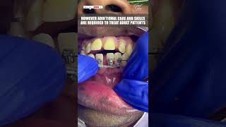 Dental braces Treatment at 60 years  No Age Limit  Adult Braces Journey  orthodontist shorts [upl. by Ahsekad]