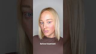 Ultimate Resurfacing Peel 🐍 skintreatment [upl. by Sherm]