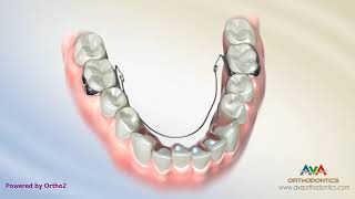 Orthodontic Expander or Spacer  Lower BiHelix Appliance [upl. by Sturges]