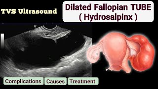 TVS Ultrasond Dilated Fallopian Tube  Hydrosalpinx [upl. by Midis]