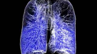 iradka Lung Emphysema COPD CT 3D [upl. by Rosenbaum888]