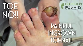 TOE NO Painful Ingrown Toenail Removal [upl. by Readus]