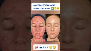 How to remove pimple acne at home✅ 🏡🧖💁viralvideo shorts [upl. by Nylasoj]