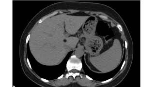 Hepatic Lipoma [upl. by Johppah]