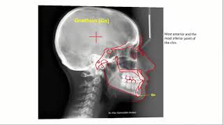 cephalometric landmarks [upl. by Ecirehc307]