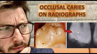 Can We Detect Occlusal Caries on Radiographs Bitewing x ray  caries removal icdas classification [upl. by Madden131]