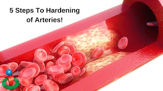 5 Things That Happen With Hardening of Arteries [upl. by Nodlew]