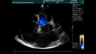 ATRIAL DILATATION PERICARDIAL EFFUSION ECHOCARDIOGRAPHYwmv [upl. by Ahsead267]