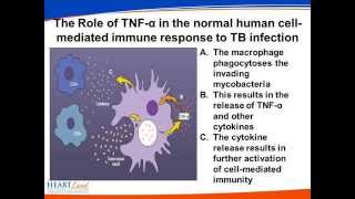 Management of Tuberculosis in Patients on TNF alpha Inhibitors [upl. by Birdella86]