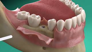 Straumann®️ GalvoSurge®️ Implant surface decontamination in periimplantitis treatment [upl. by Noiwtna]