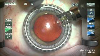 Corneal Relxing Incision Technique [upl. by Ielirol]